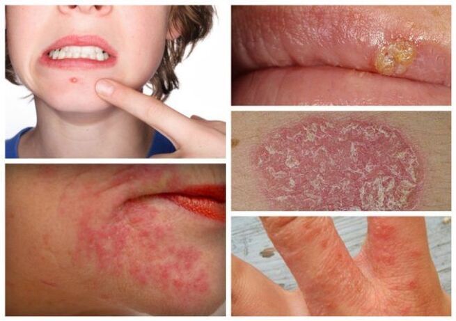 Alergije in kožne bolezni so znaki parazitov v telesu