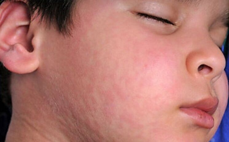Alergijski izpuščaji na koži - simptom prisotnosti parazitskih črvov v telesu